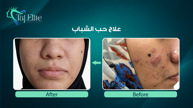 before-^-after13